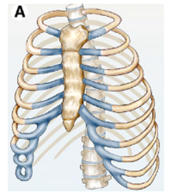 Figura 1 – Pectus excavatum tipo grand canyon.