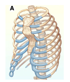 Figura 2 – Pectus excavatum tipo cup.