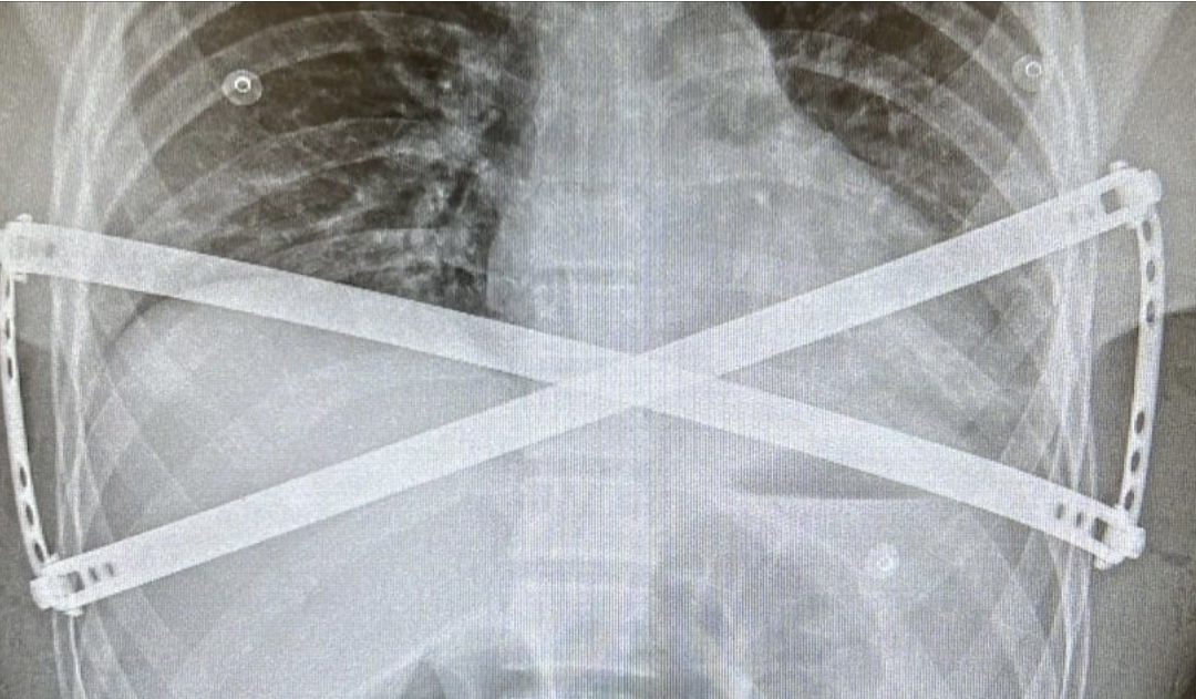 Cryoanalgesia in MIRPE