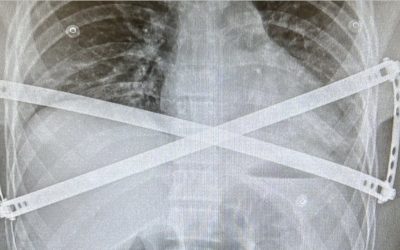 Cryoanalgesia in MIRPE