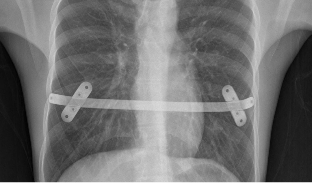 Is it the end of MIRPE (Minimally Invasive Repair of Pectus Excavatum)?