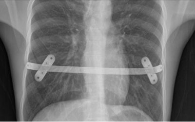 Is it the end of MIRPE (Minimally Invasive Repair of Pectus Excavatum)?